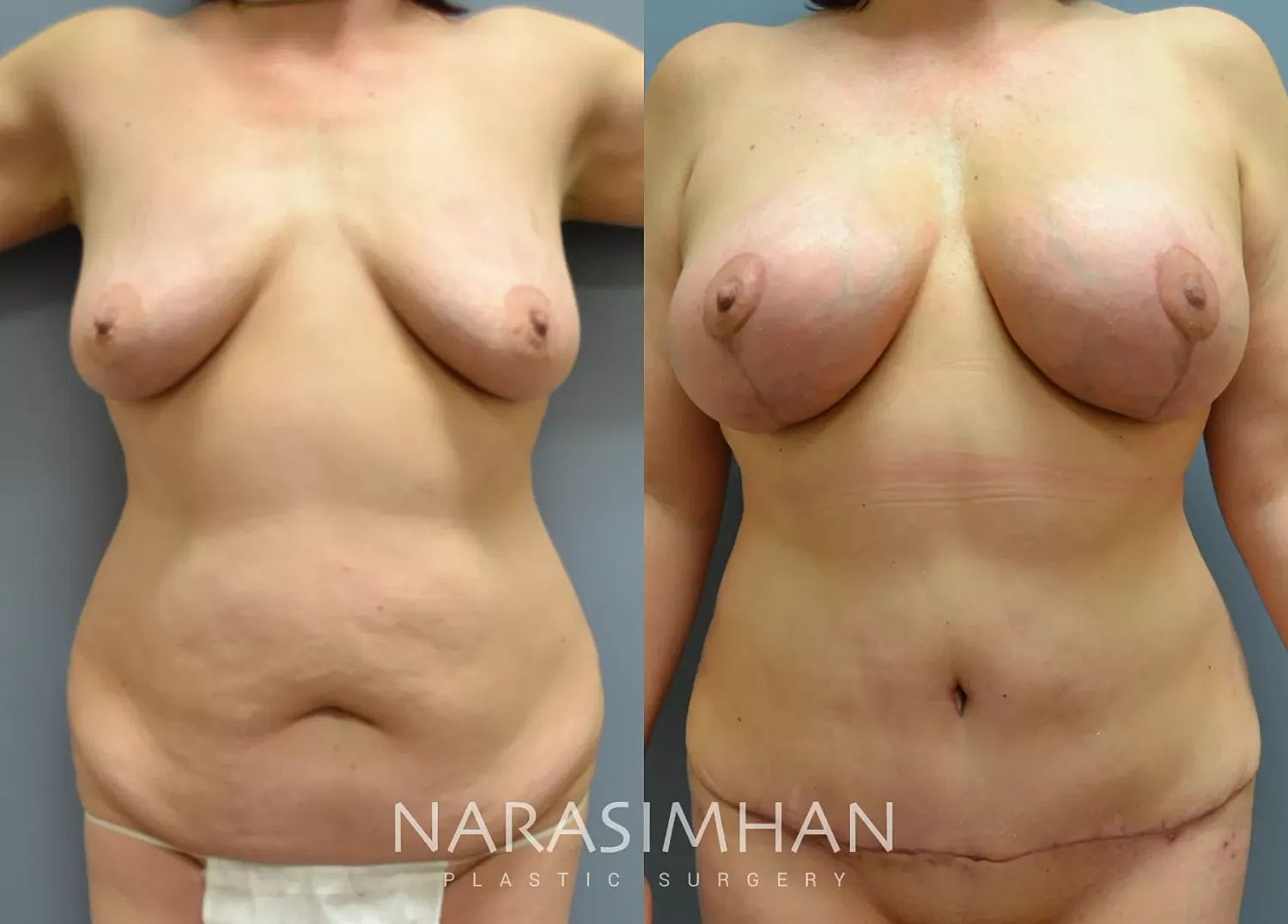 Mastopexy Before & After