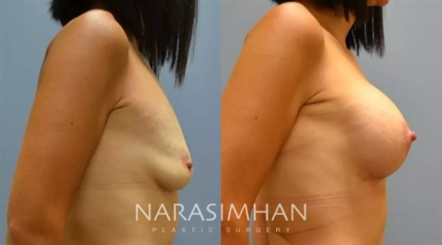 Mastopexy Before & After