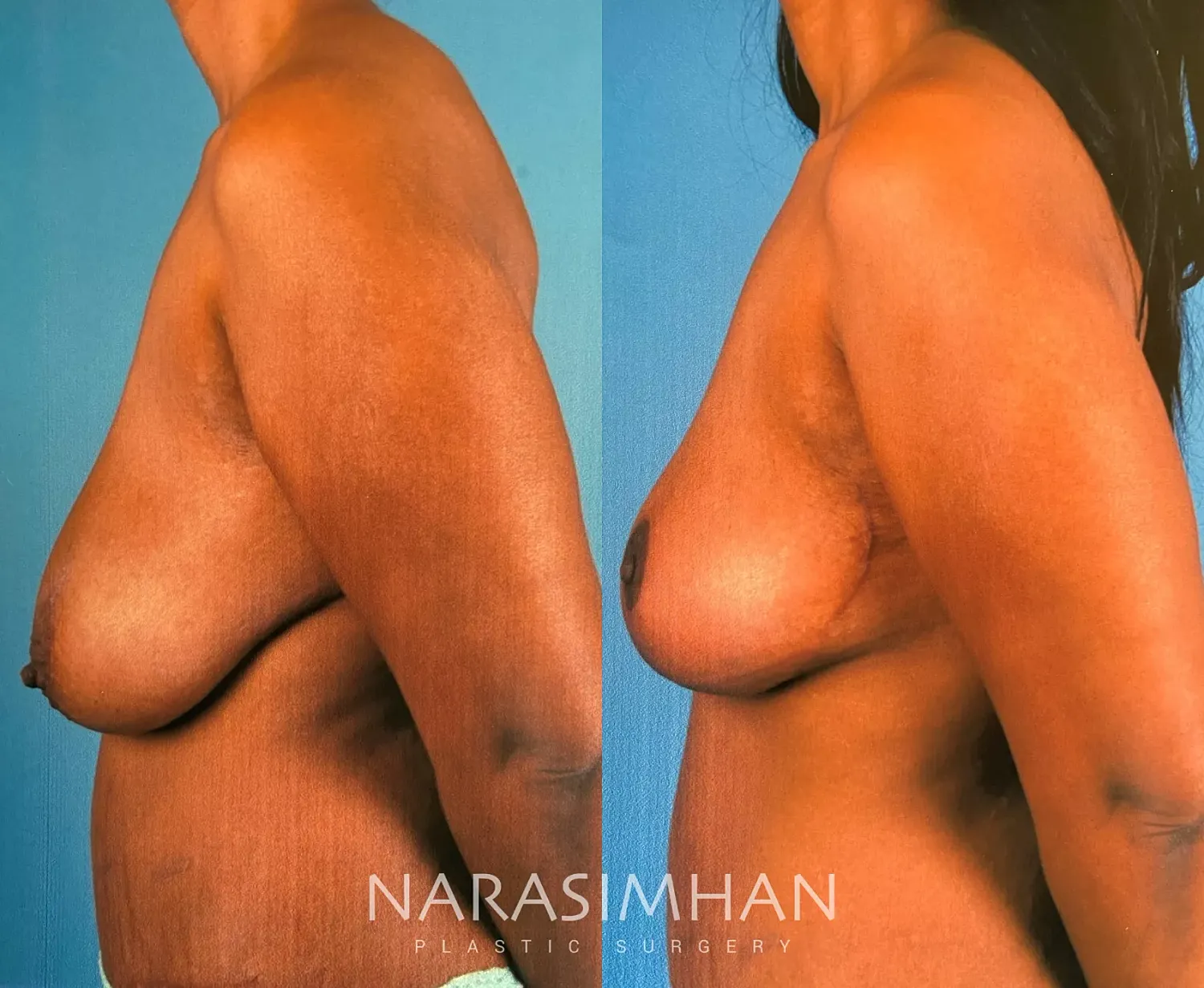 Mastopexy Before & After