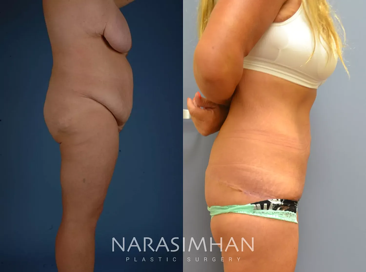 Tummy Tuck Before & After