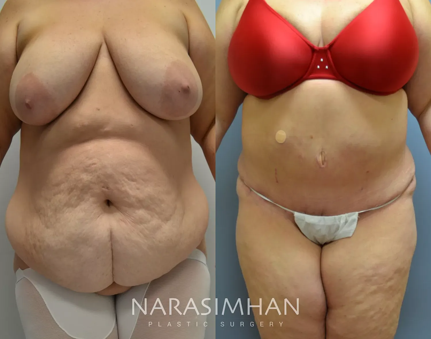 Tummy Tuck Before & After