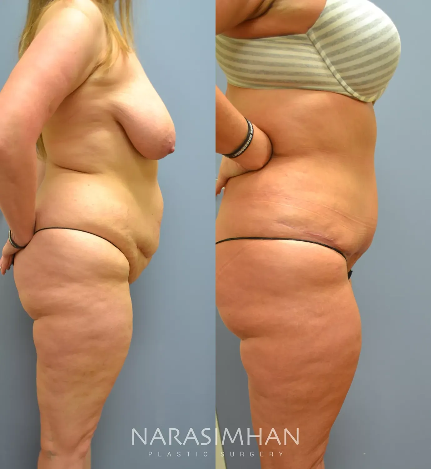 Tummy Tuck Before & After