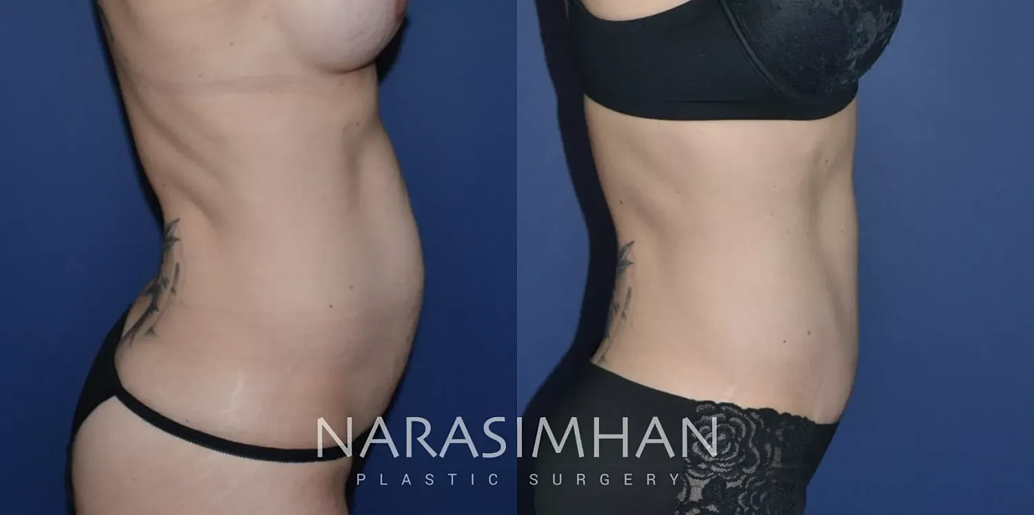 Tummy Tuck Before & After