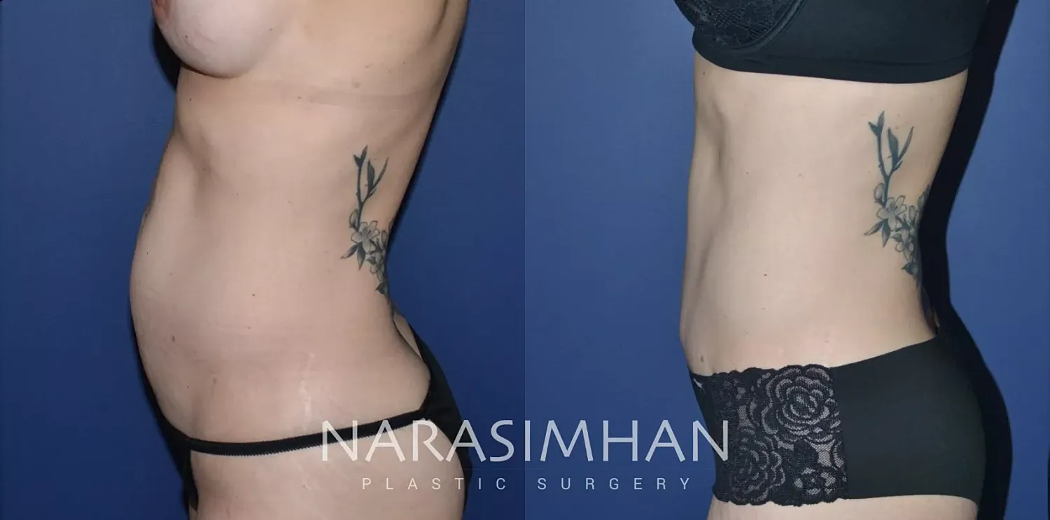 Tummy Tuck Before & After