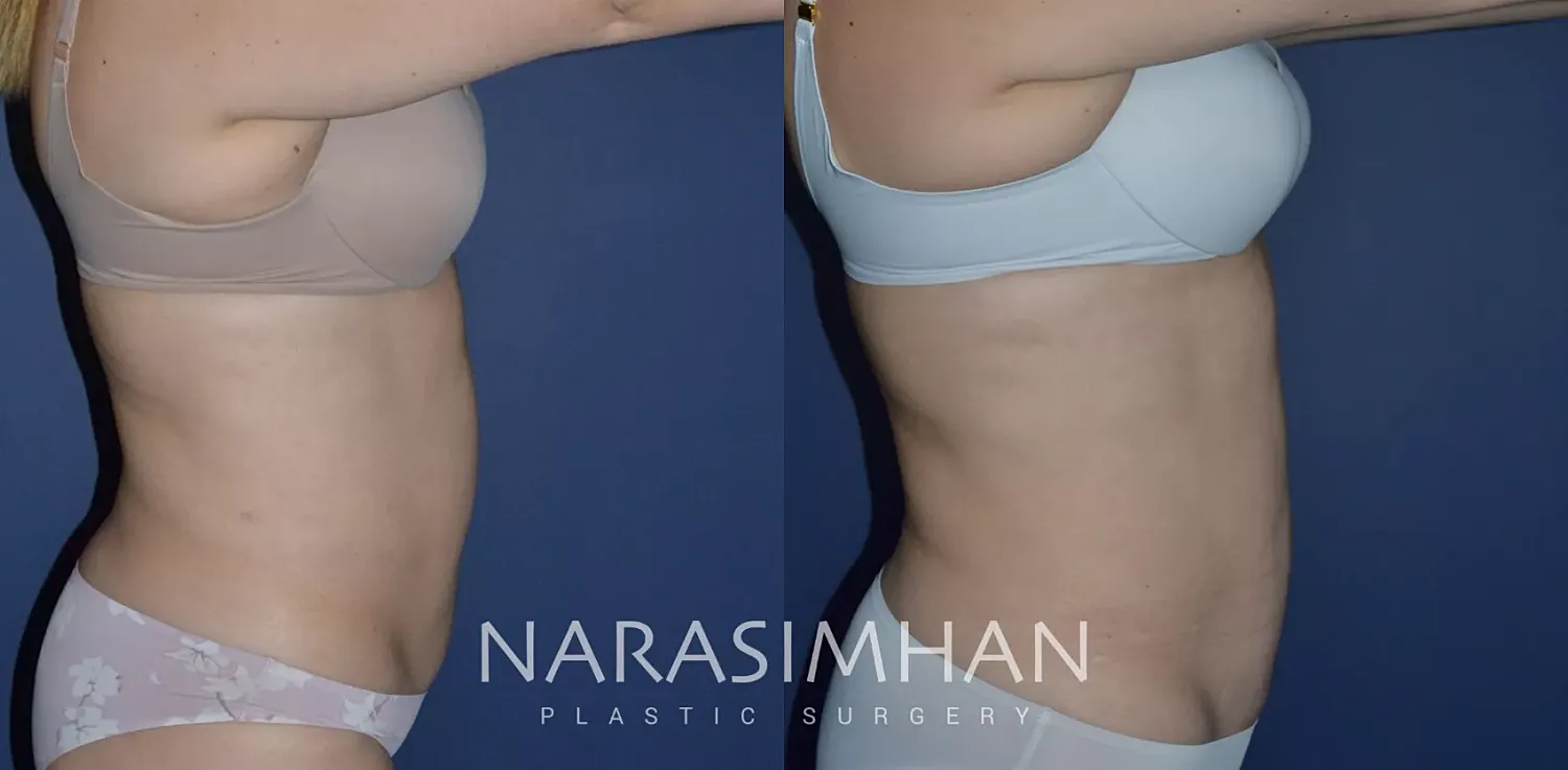 Tummy Tuck Before & After
