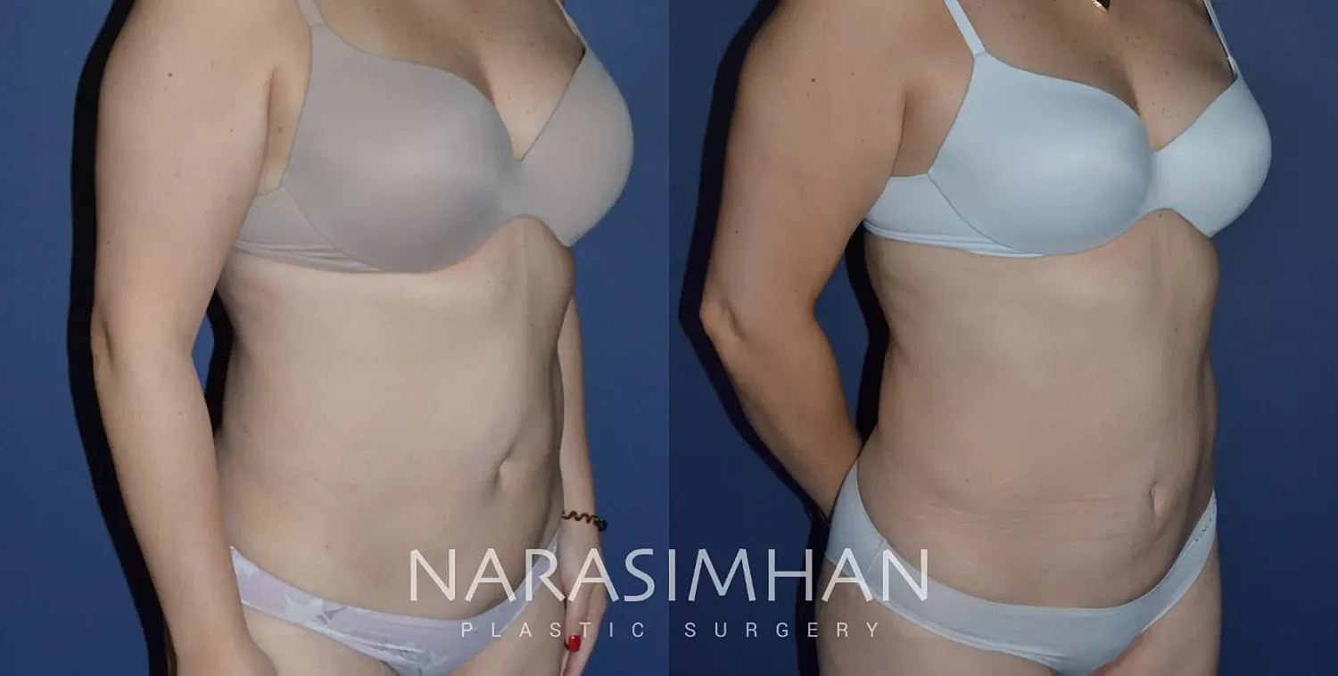 Tummy Tuck Before & After