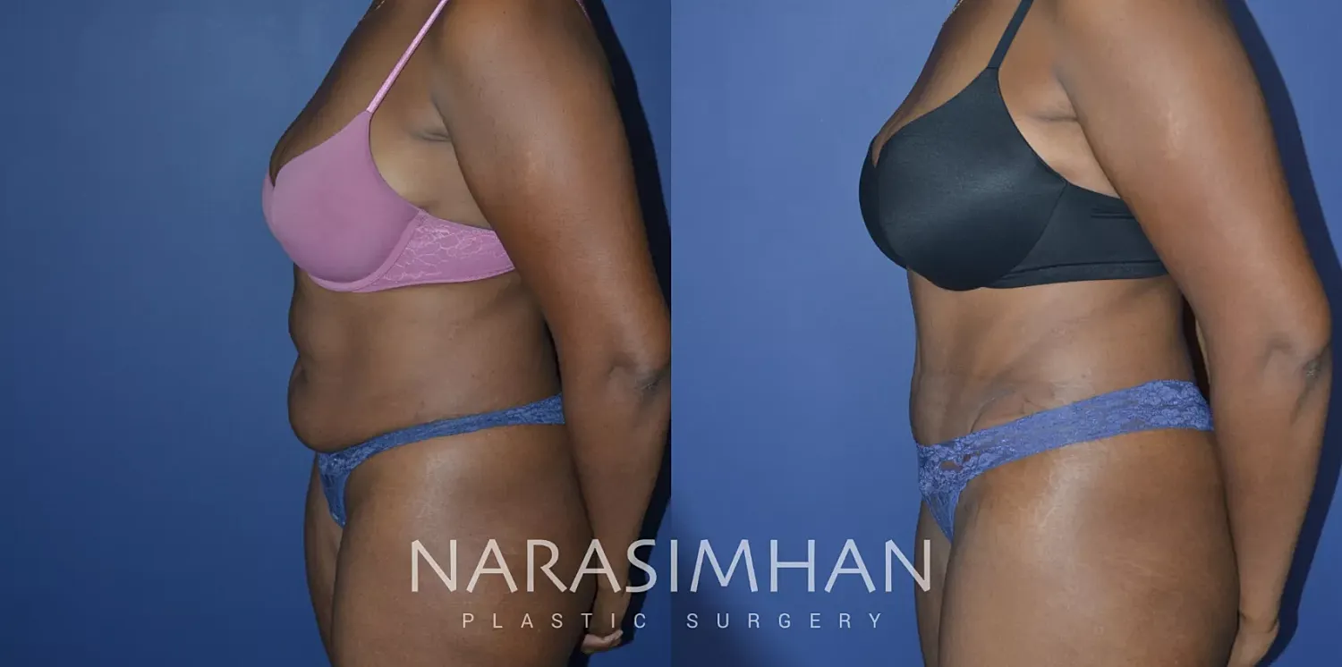 Tummy Tuck Before & After
