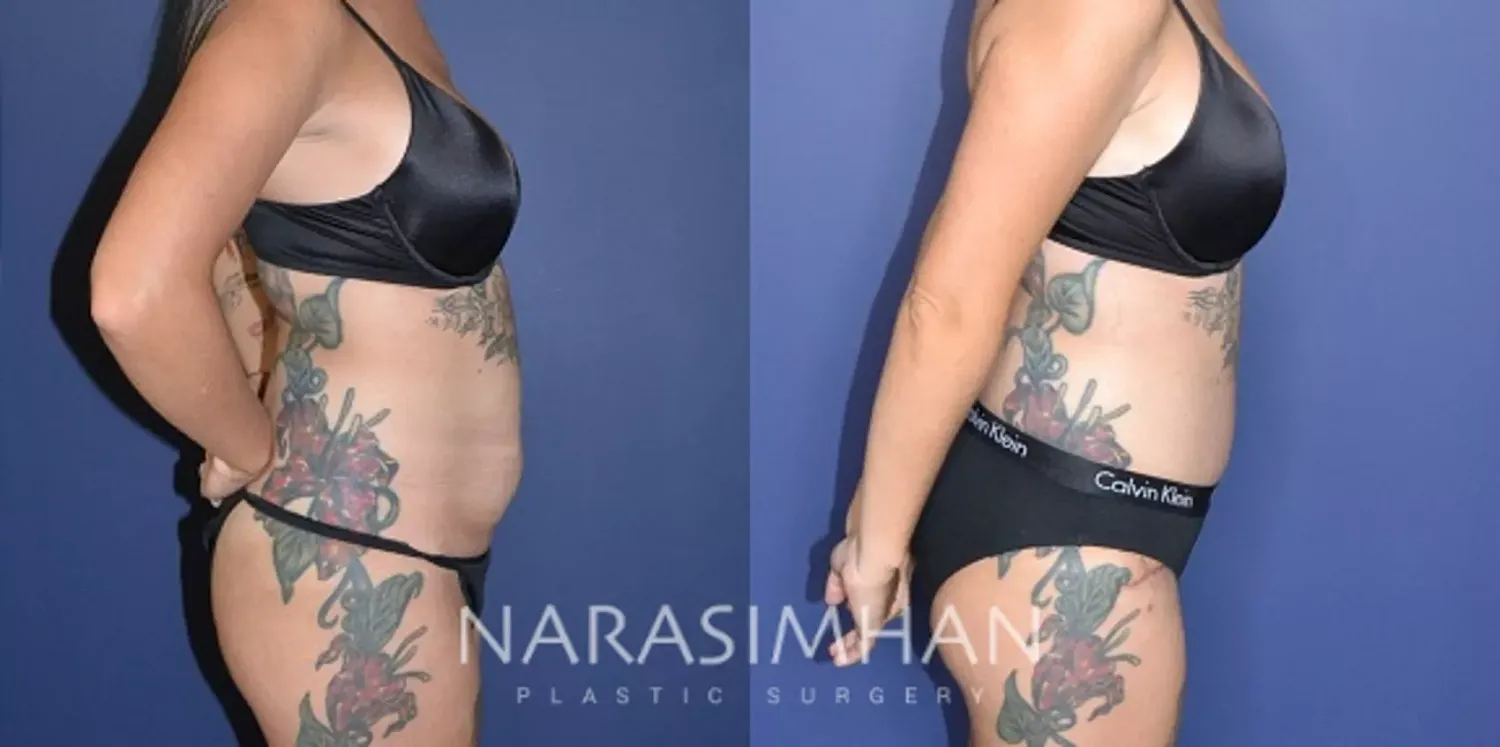 Tummy Tuck Before & After