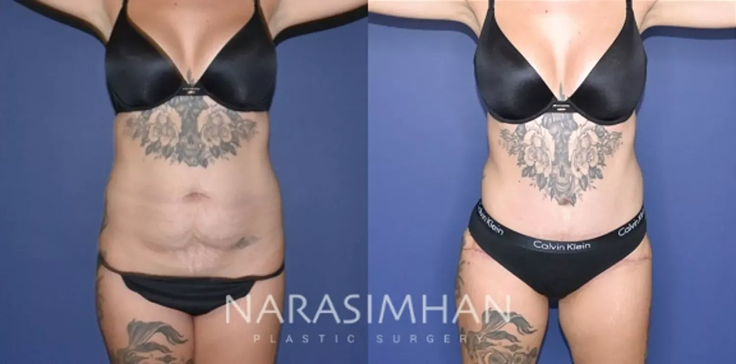 Tummy Tuck Before & After