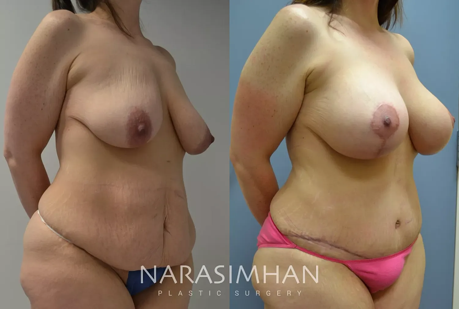Tummy Tuck Before & After