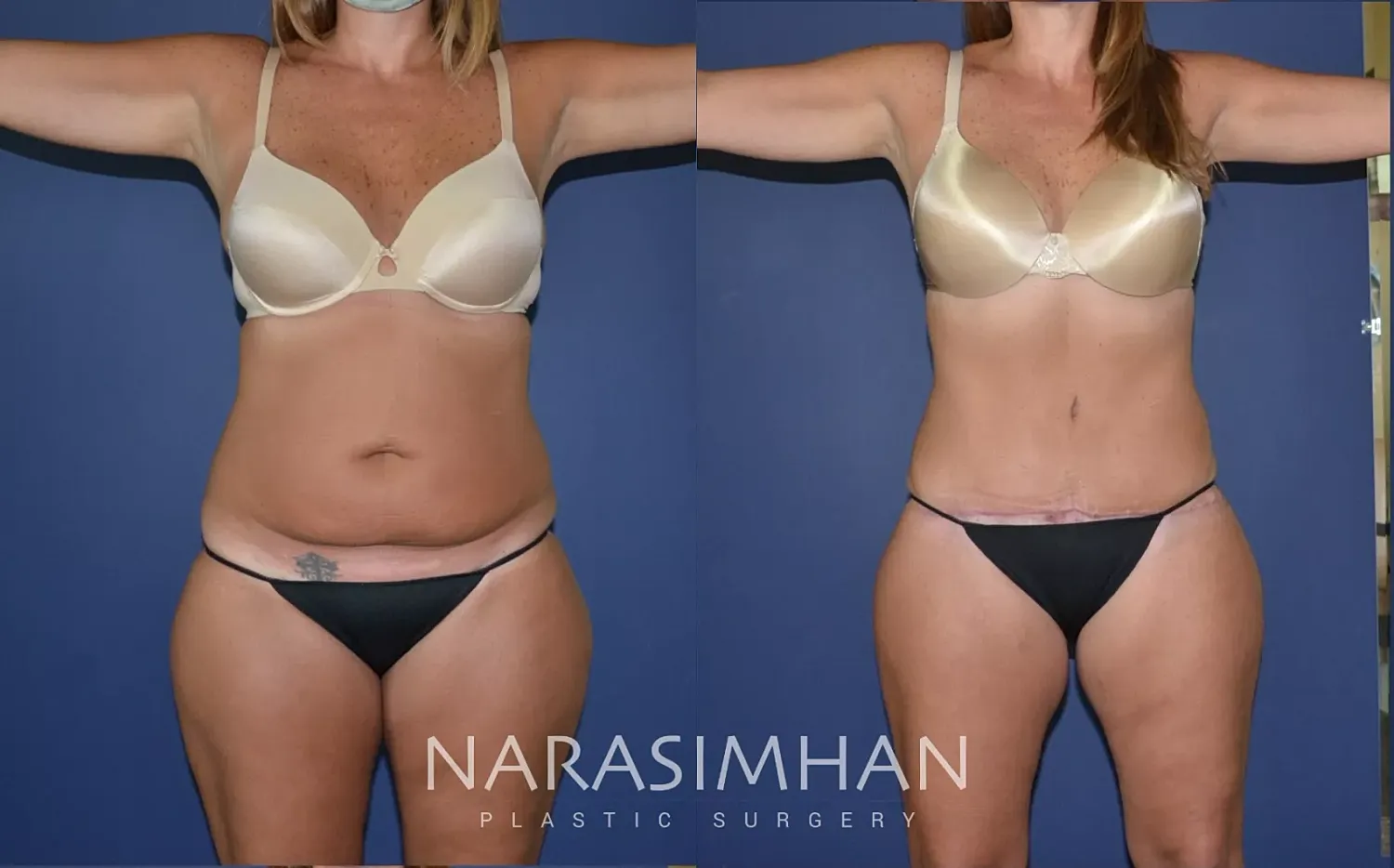 Tummy Tuck Before & After