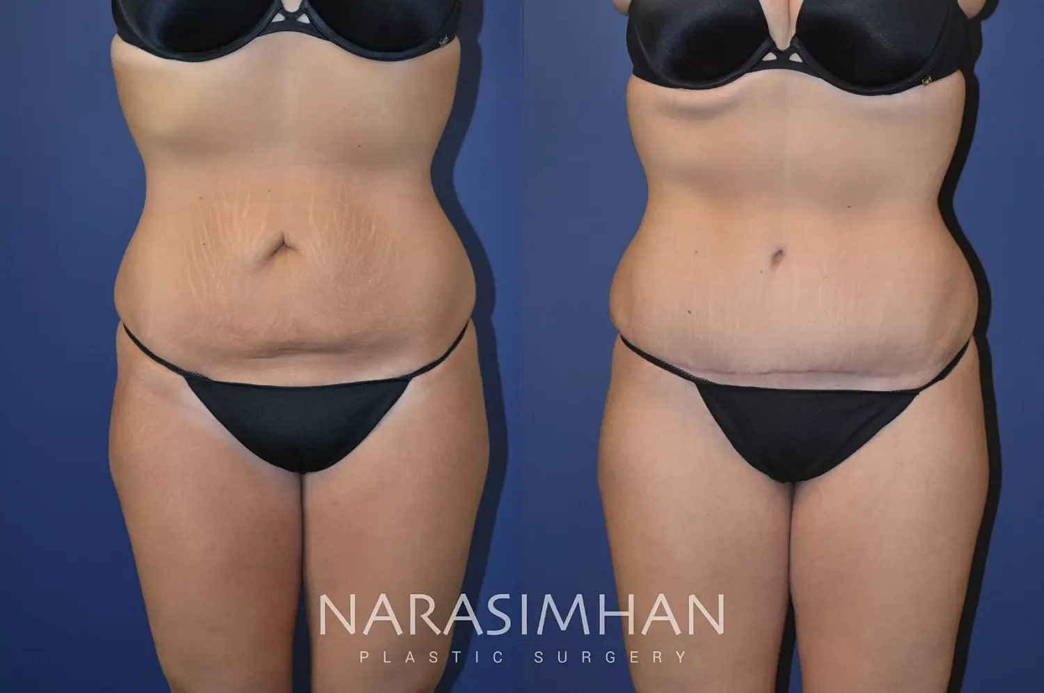 Tummy Tuck Before & After
