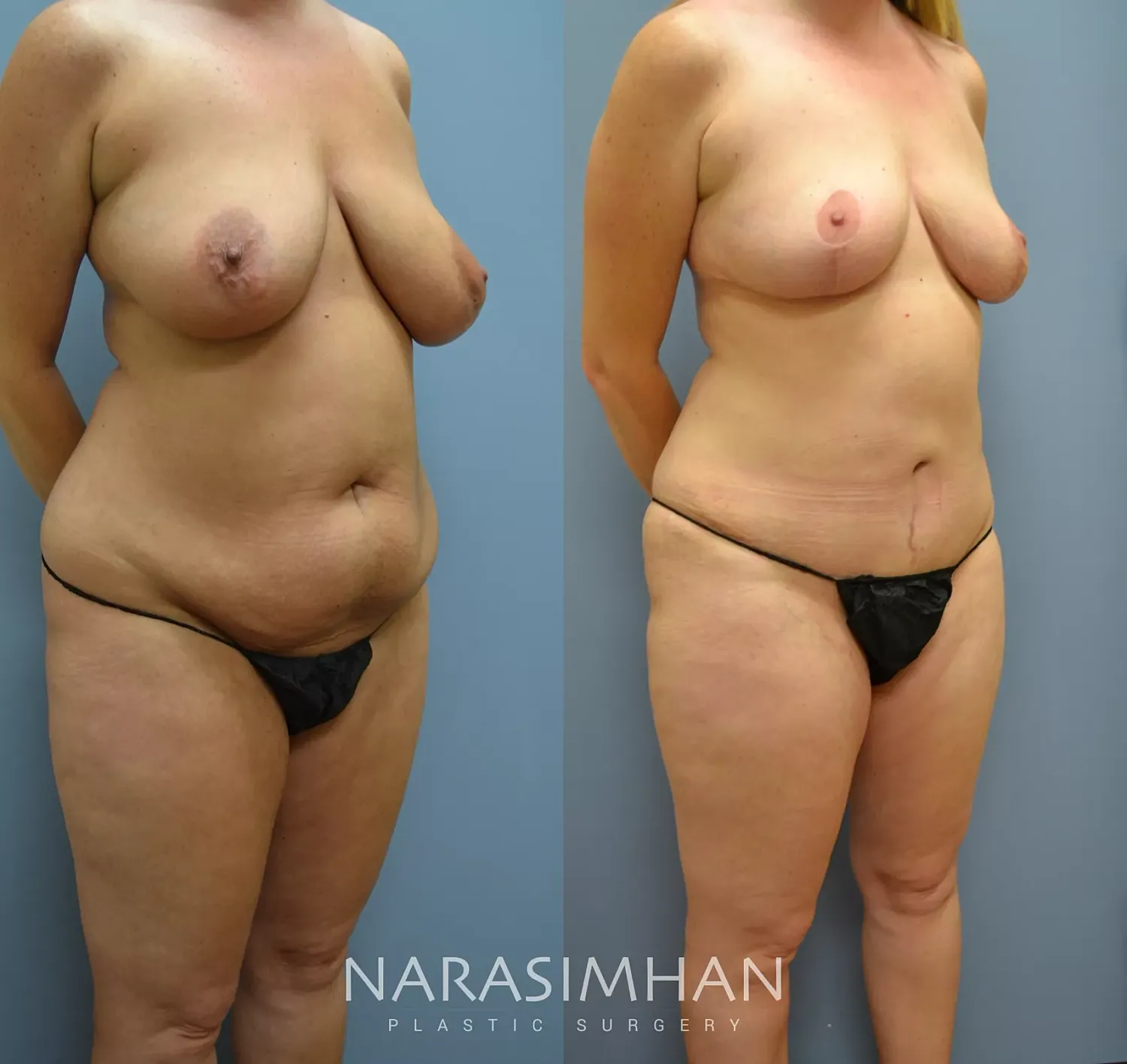 Tummy Tuck Before & After
