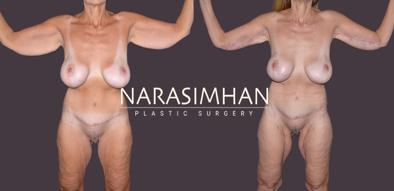 Post Weight Loss Skin Tightening Before & After