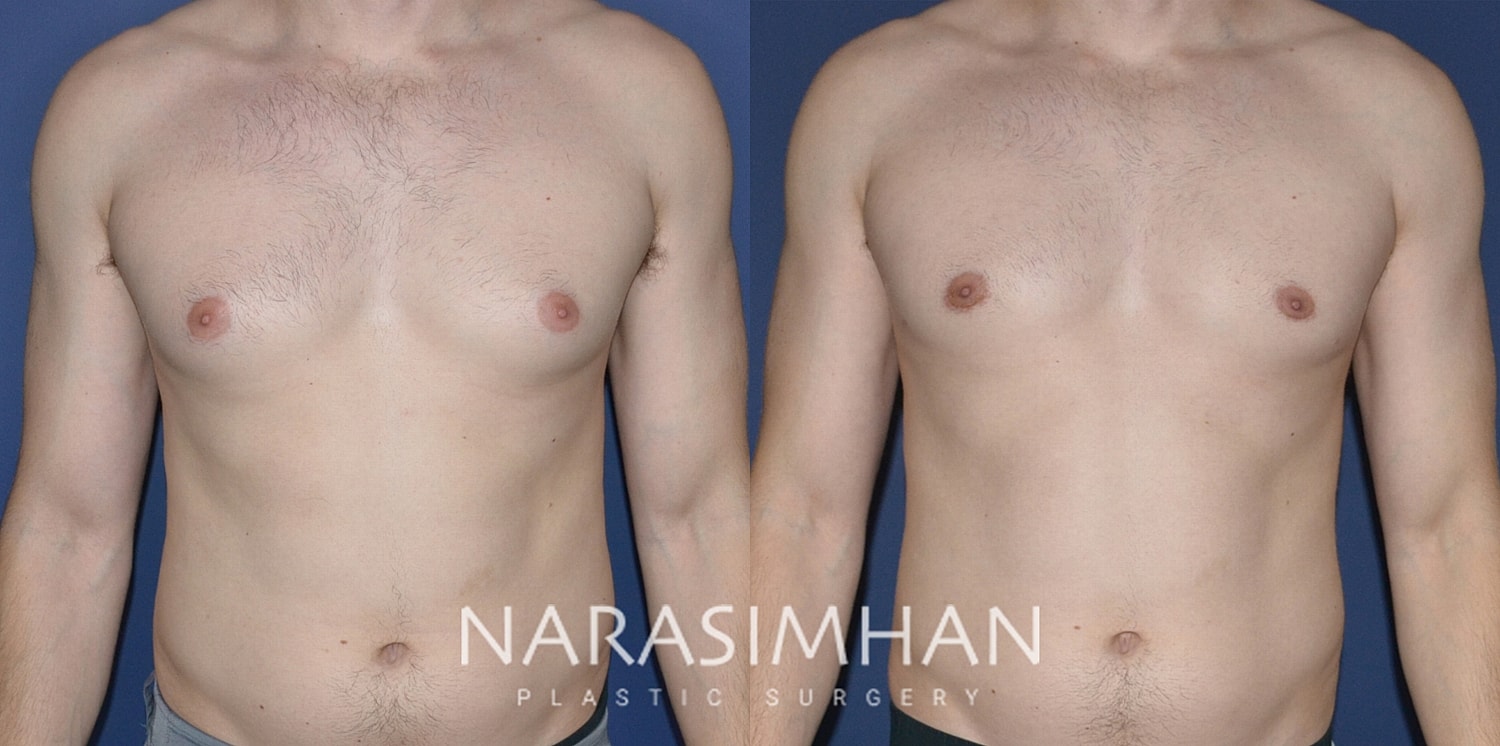 Gynecomastia Before & After