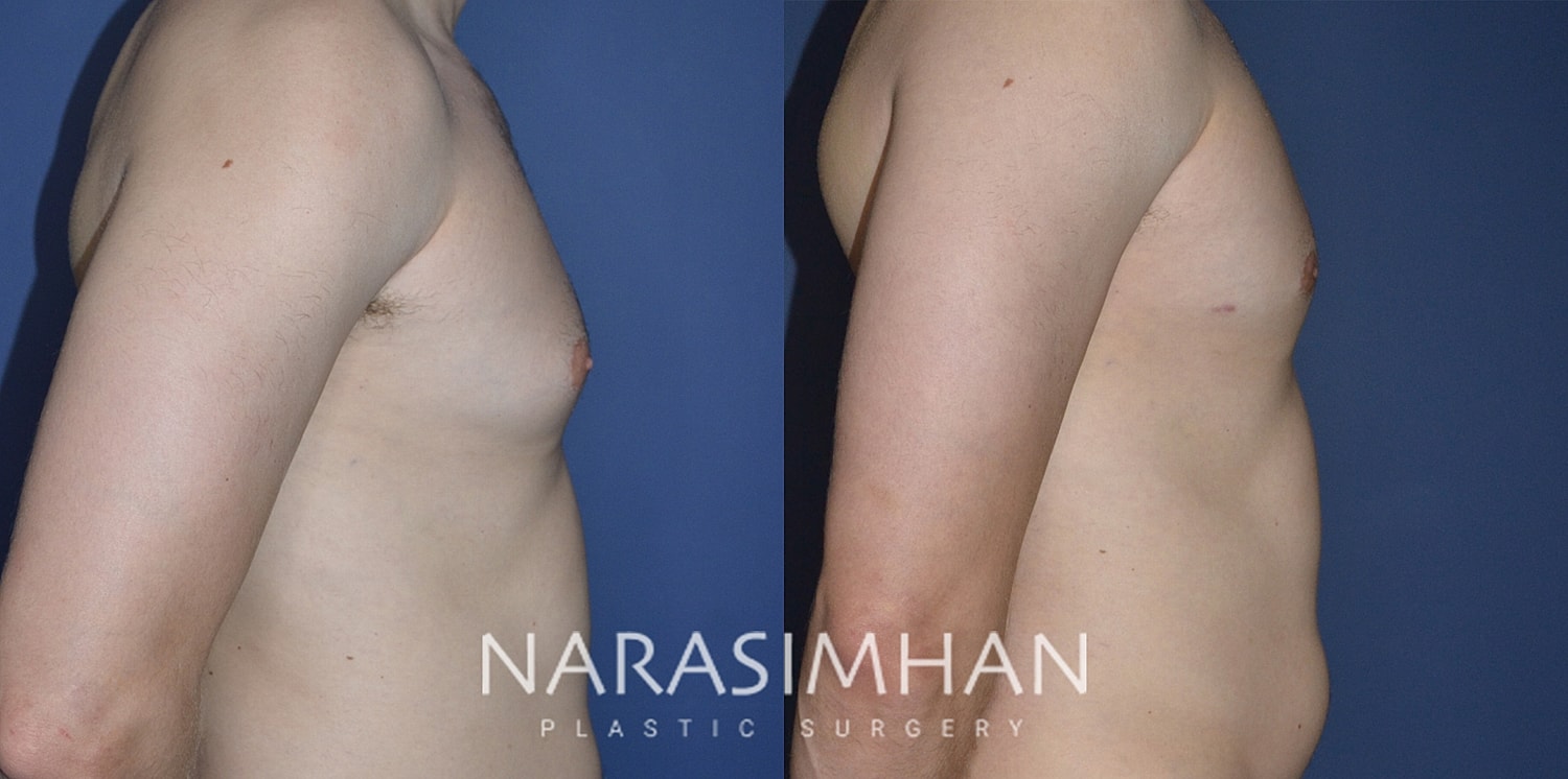 Gynecomastia Before & After