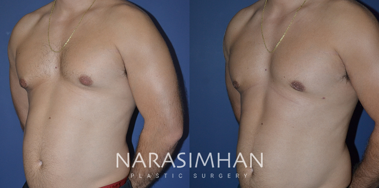 Gynecomastia Before & After