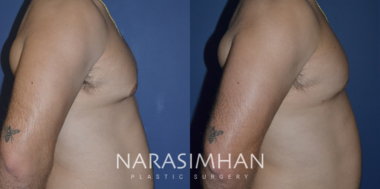 Gynecomastia Before & After