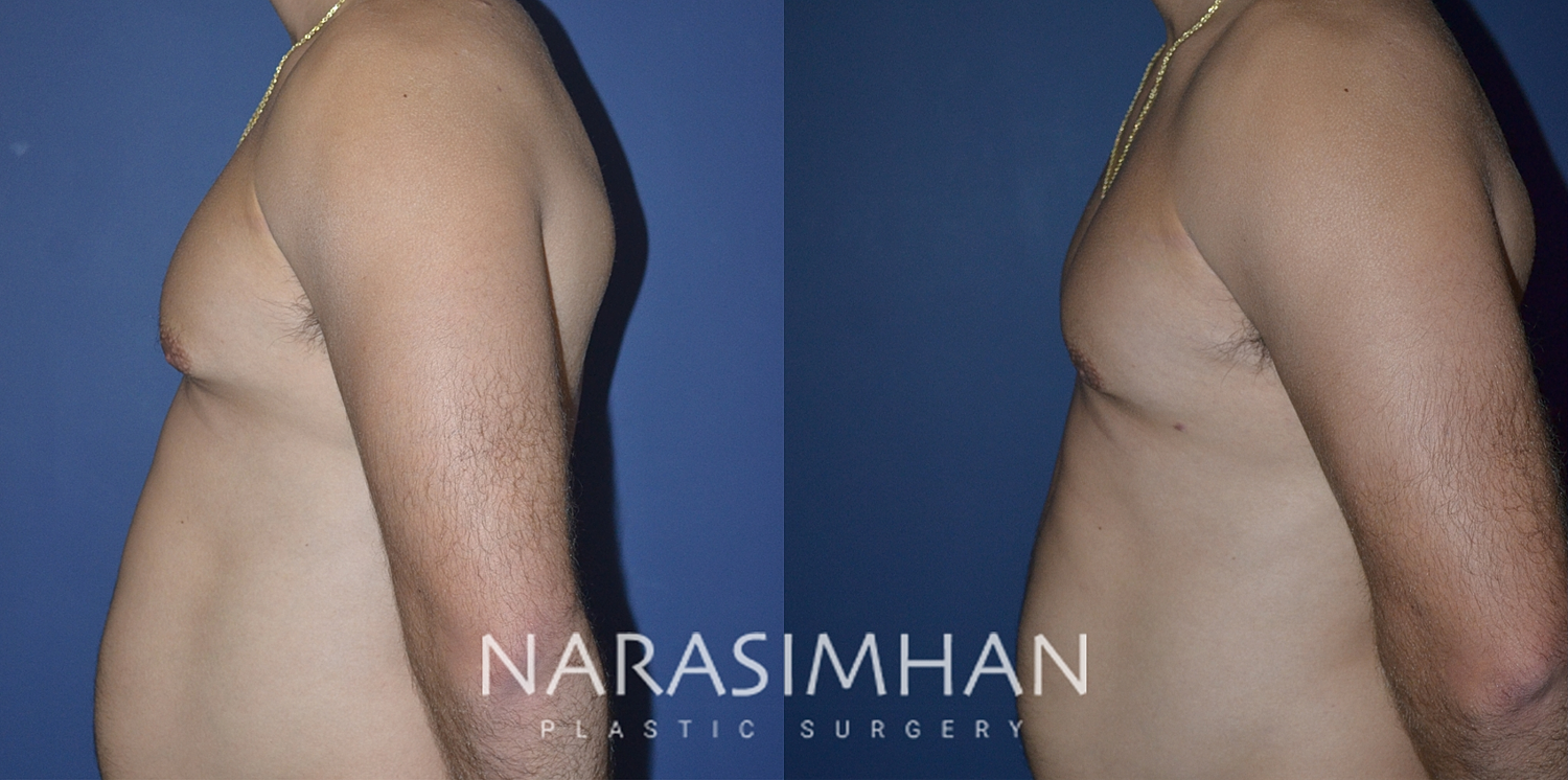Gynecomastia Before & After