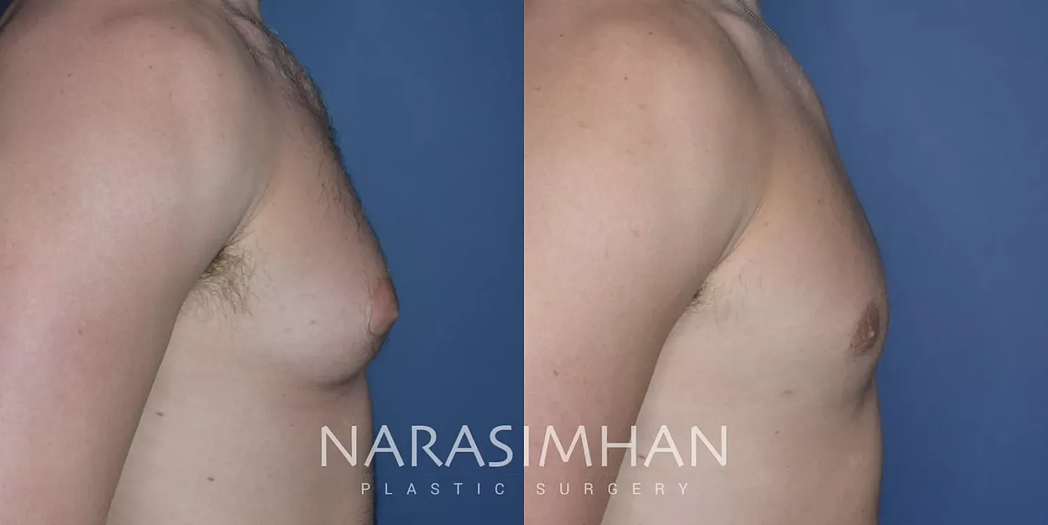 Gynecomastia Before & After