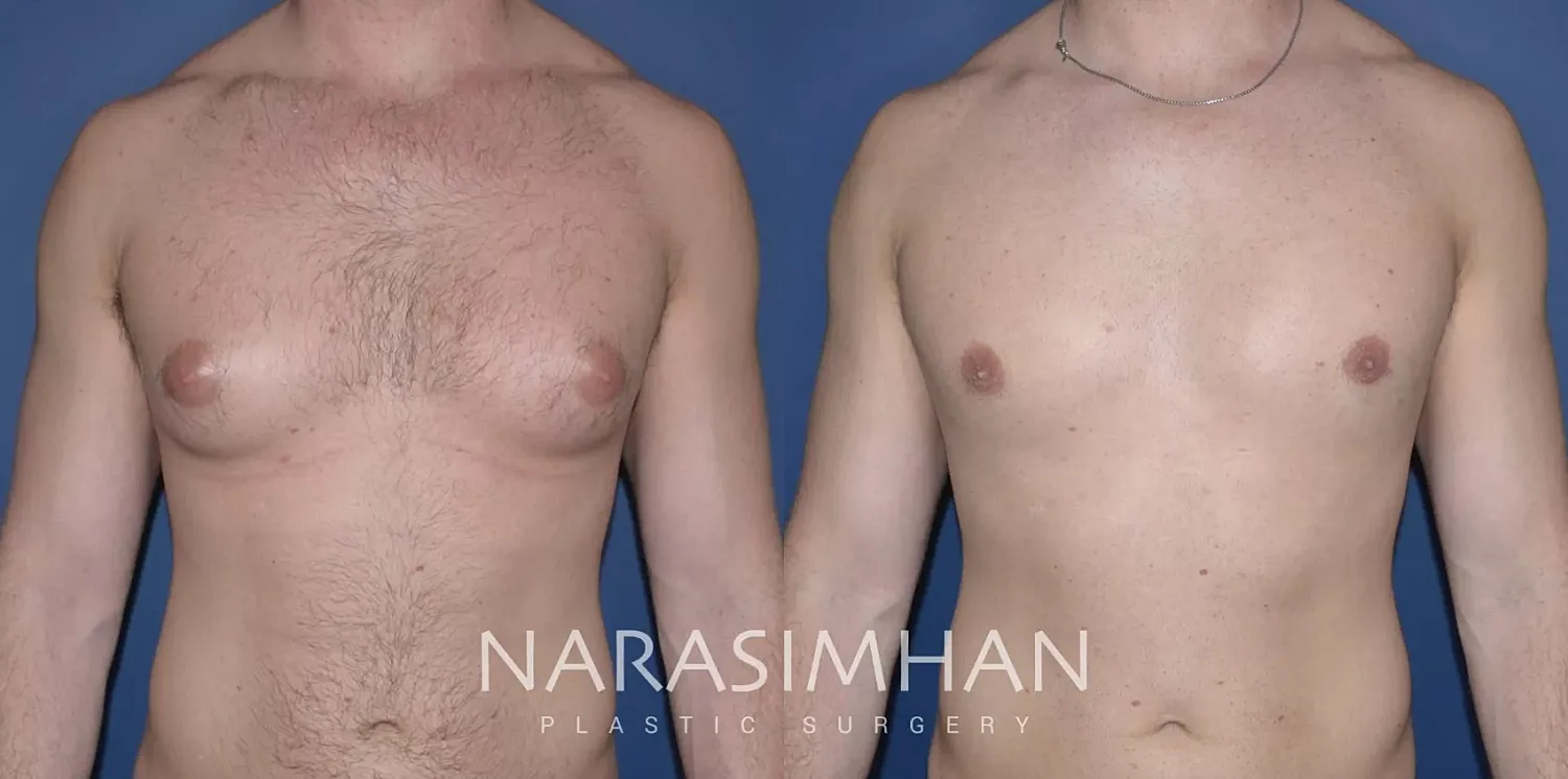 Gynecomastia Before & After