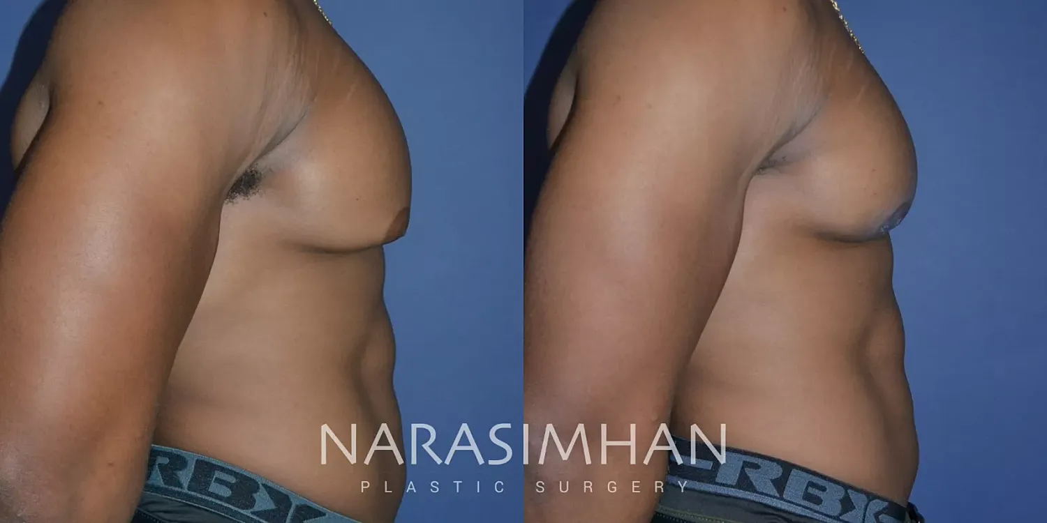Gynecomastia Before & After