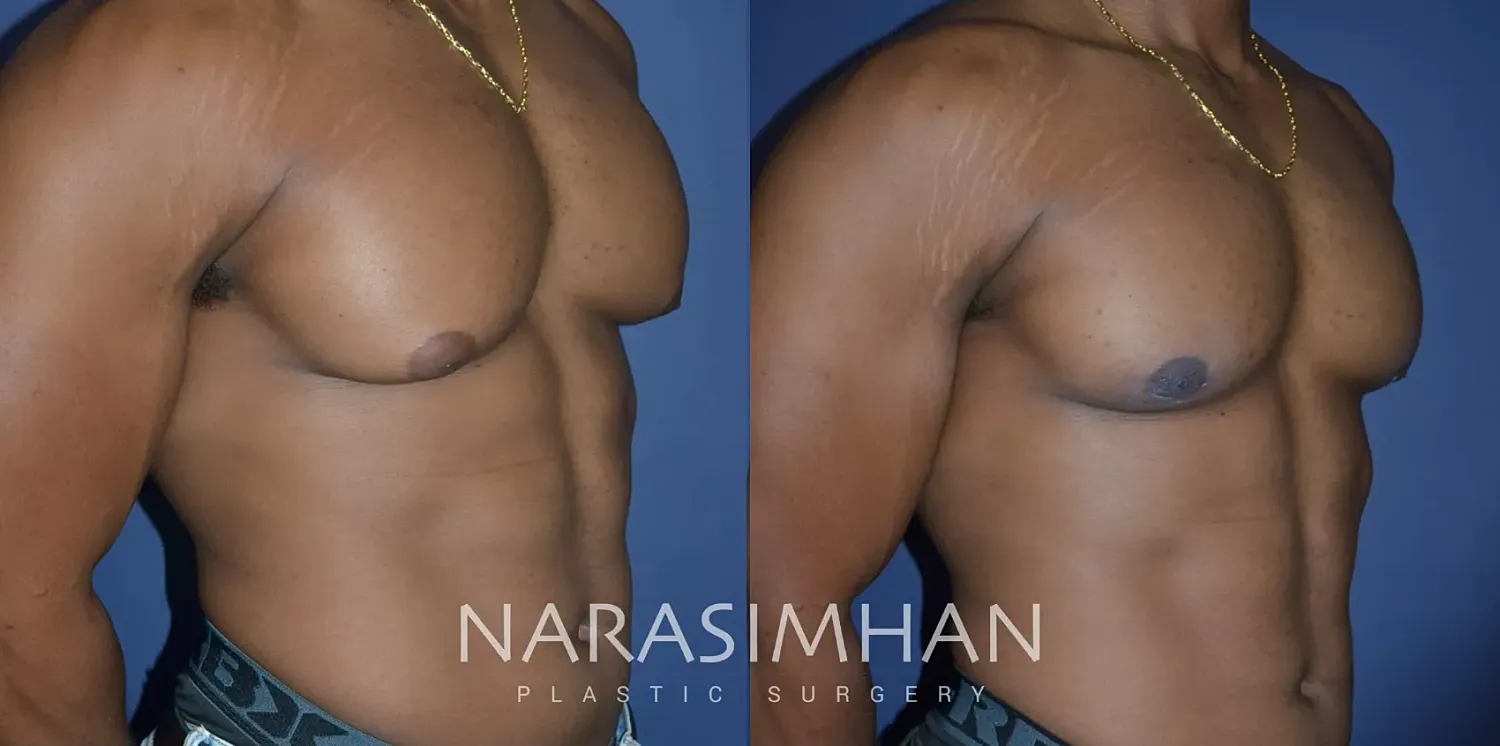 Gynecomastia Before & After
