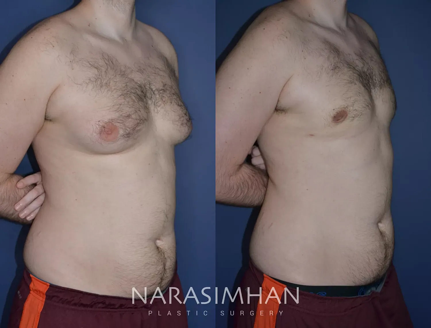 Gynecomastia Before & After