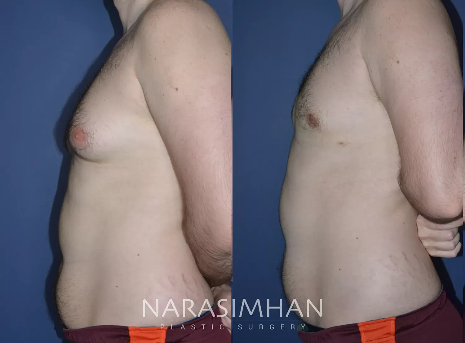 Gynecomastia Before & After