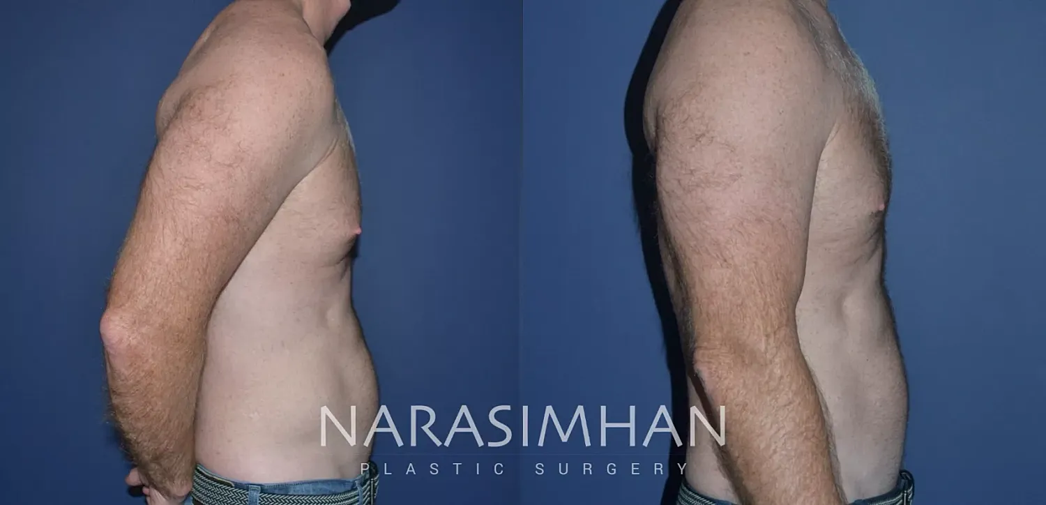 Gynecomastia Before & After