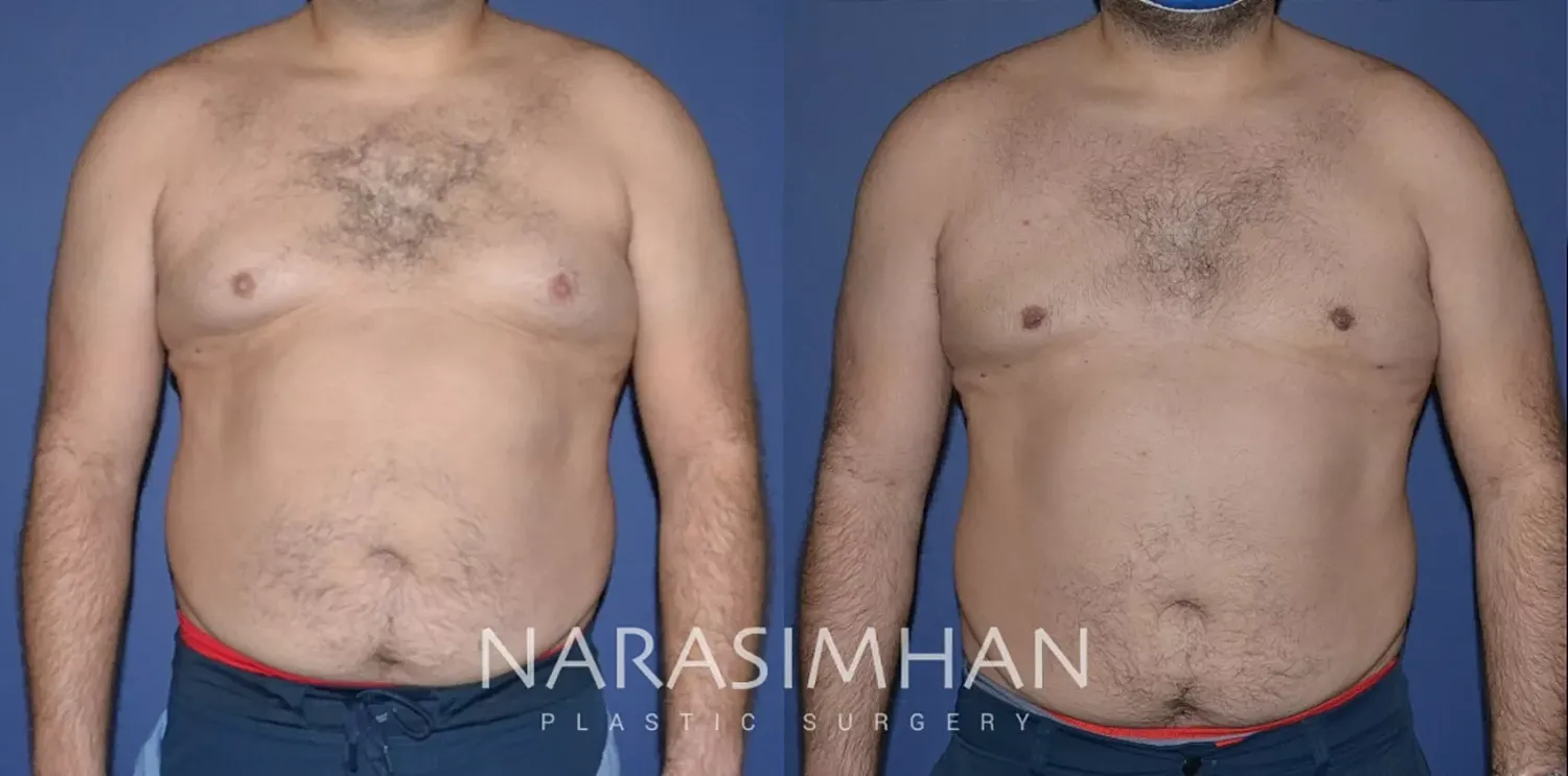 Gynecomastia Before & After