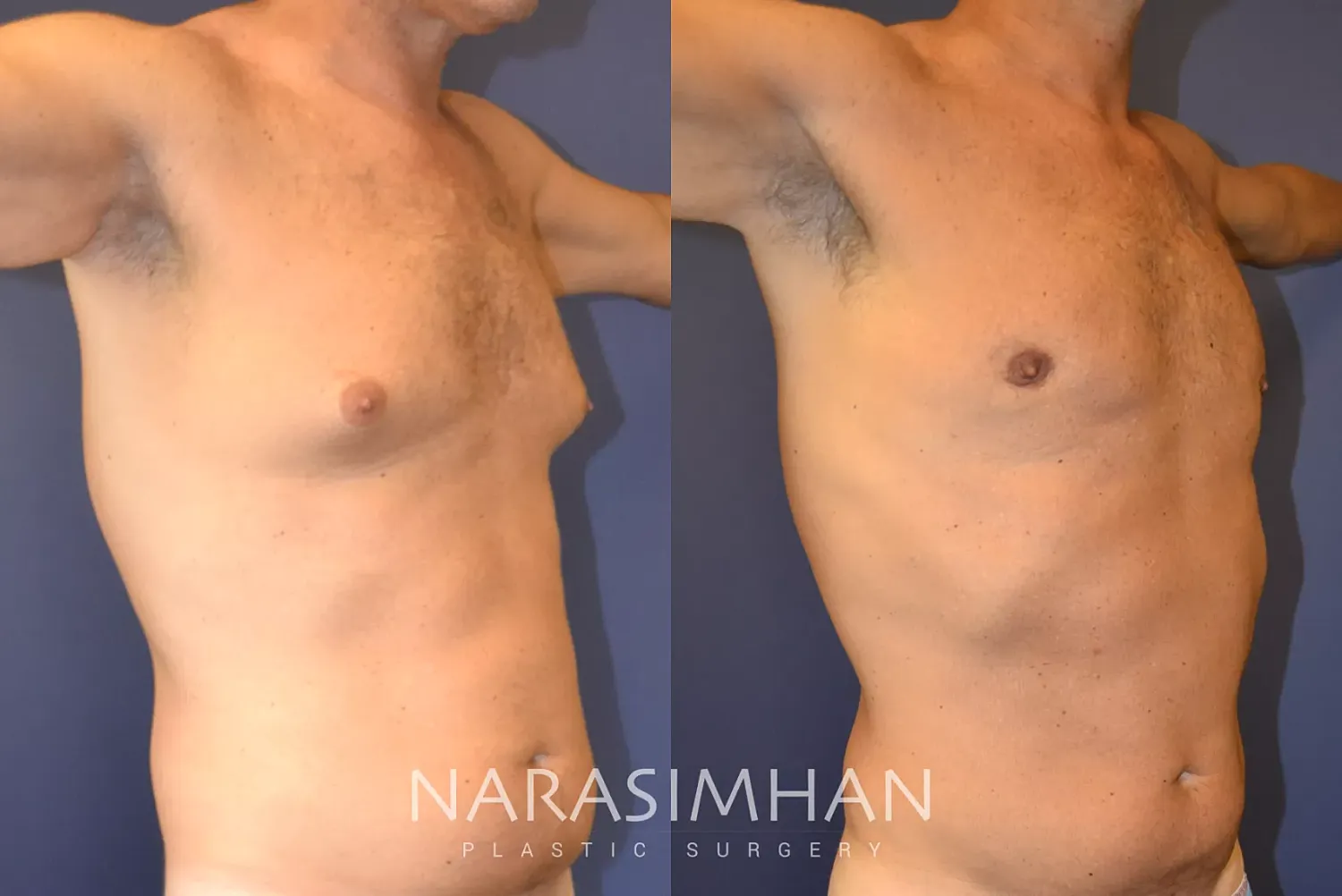 Gynecomastia Before & After