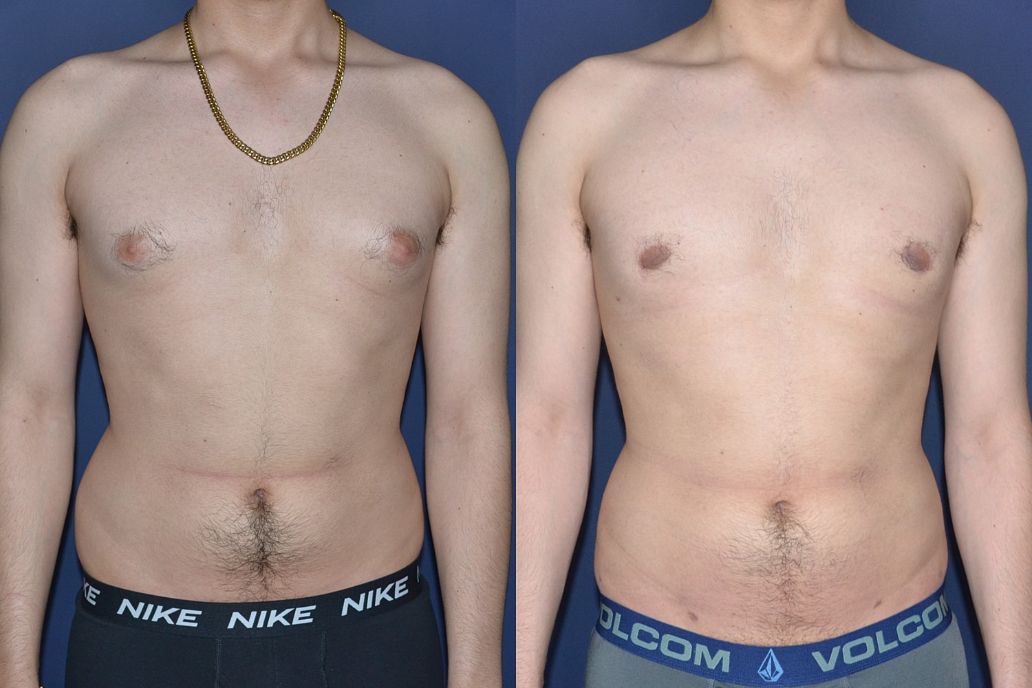 Before and after torso transformation comparison.