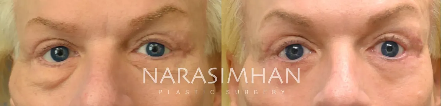 Blepharoplasty Before & After