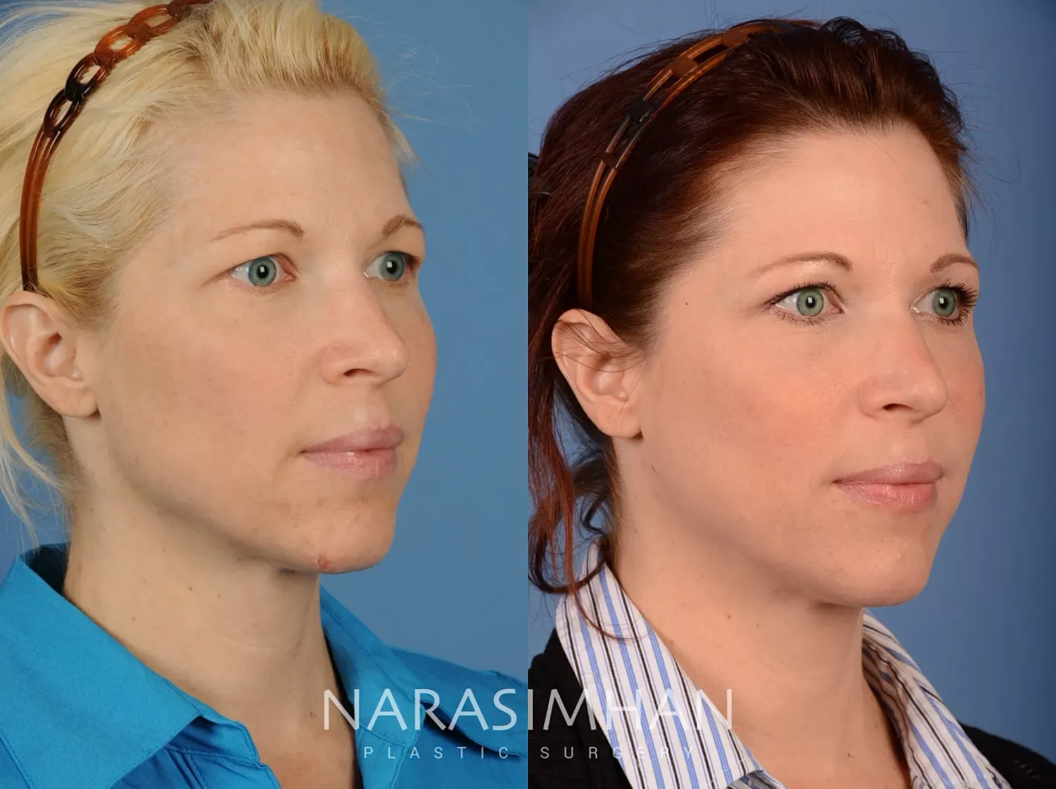 Blepharoplasty Before & After