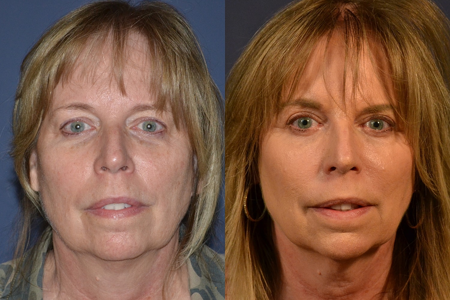 Blepharoplasty Before & After