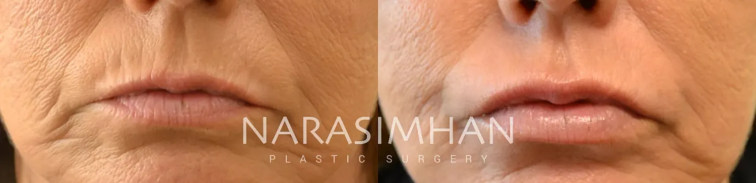 Lip Filler Before & After