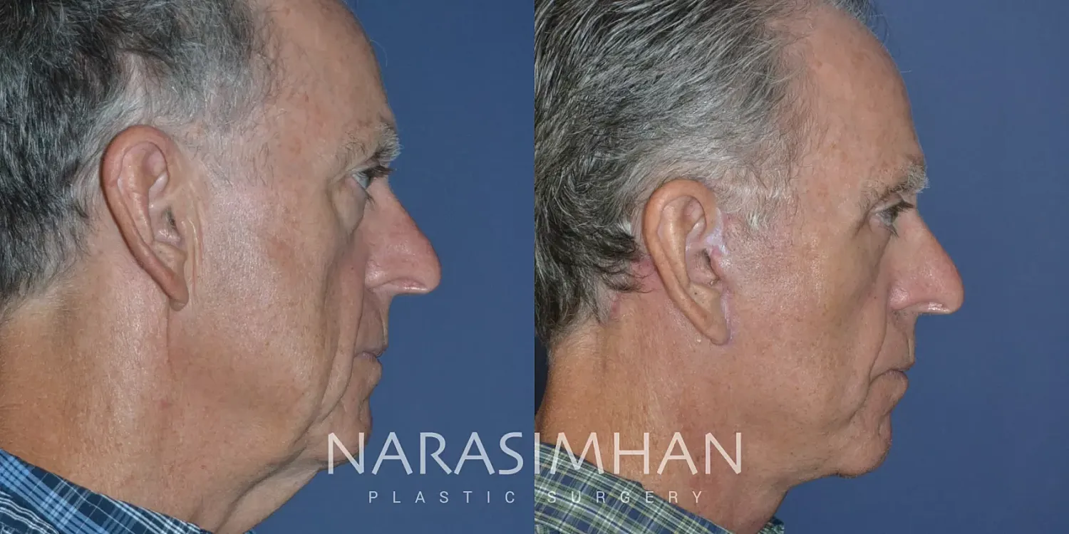 Male Facelift Before & After