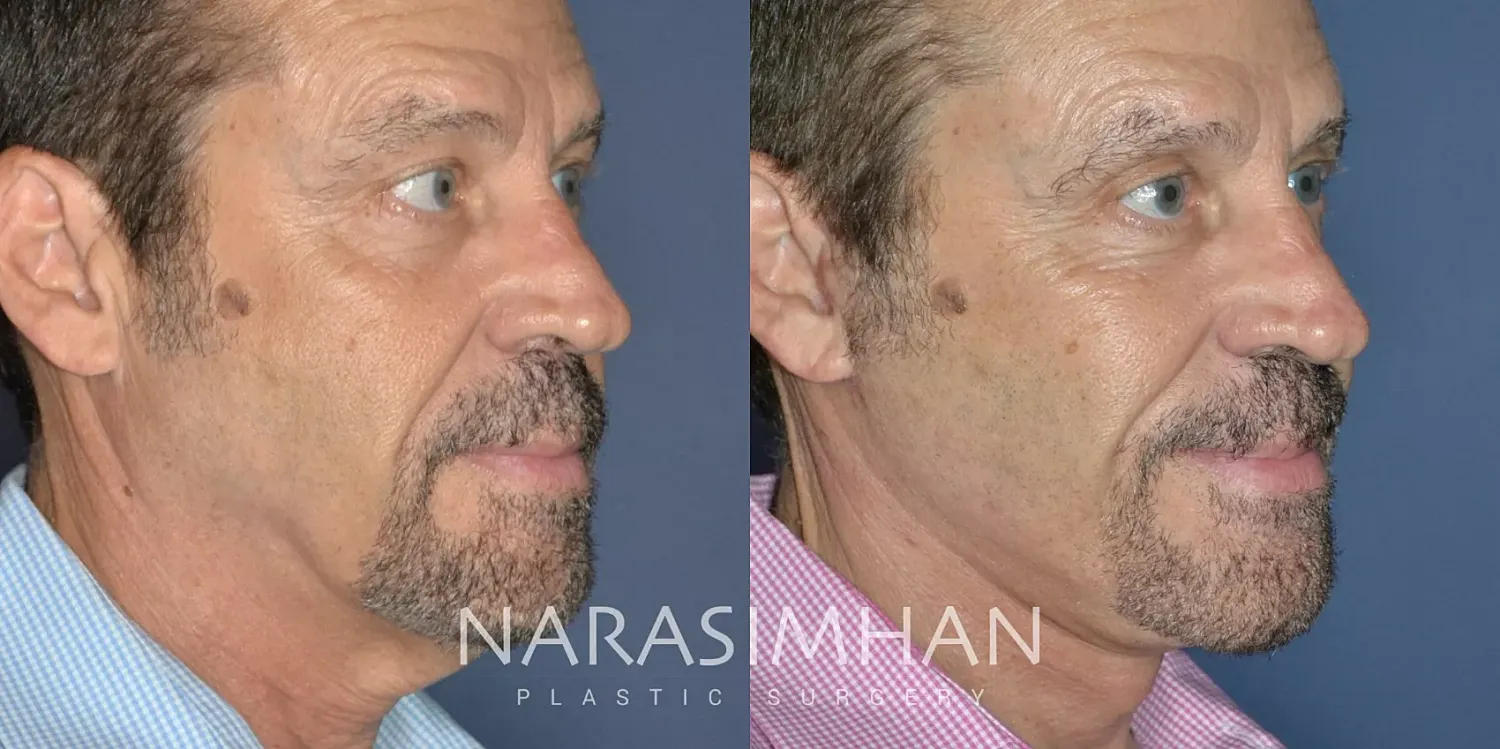 Male Facelift Before & After