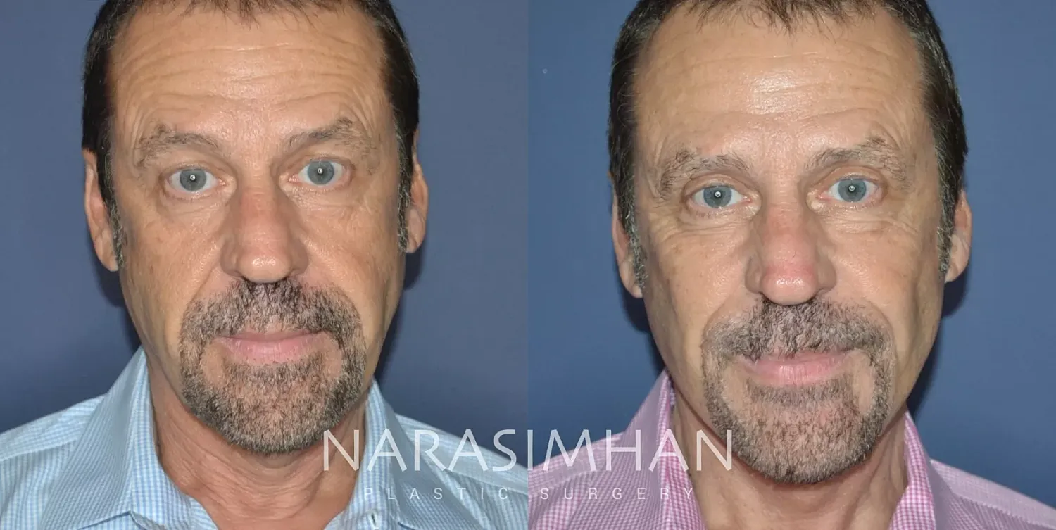 Male Facelift Before & After