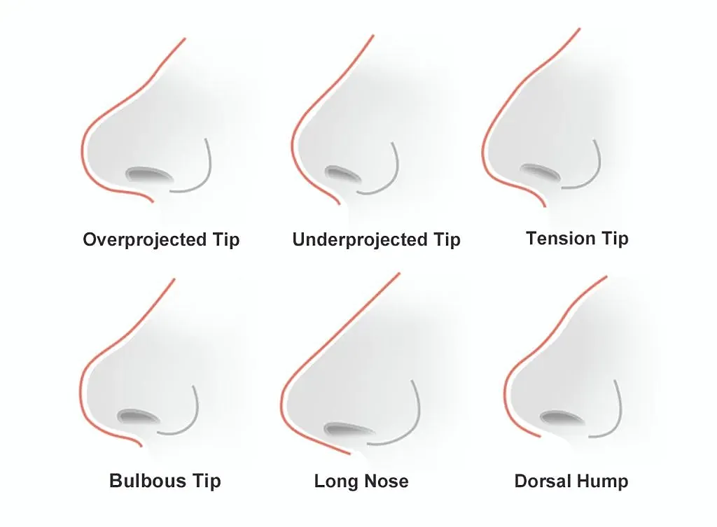 Nose shape variations and their descriptions.