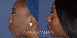 african-american-rhinoplasty-247-view-4-custom-250px