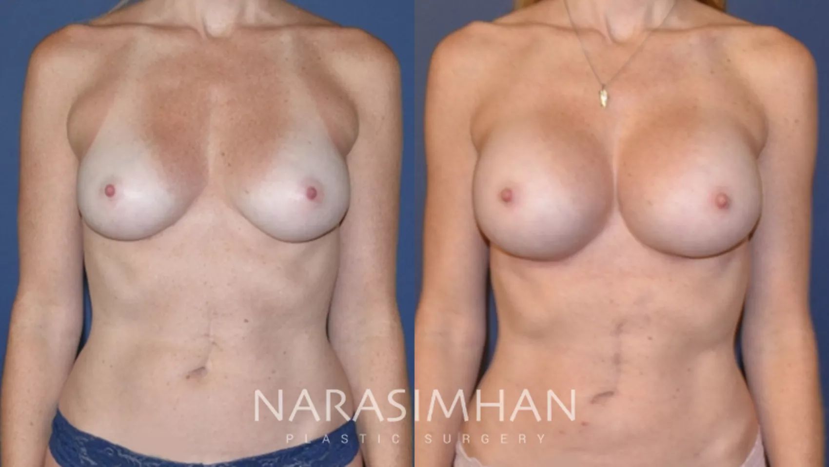 breast-augmentation-145-view-1-detail (1)