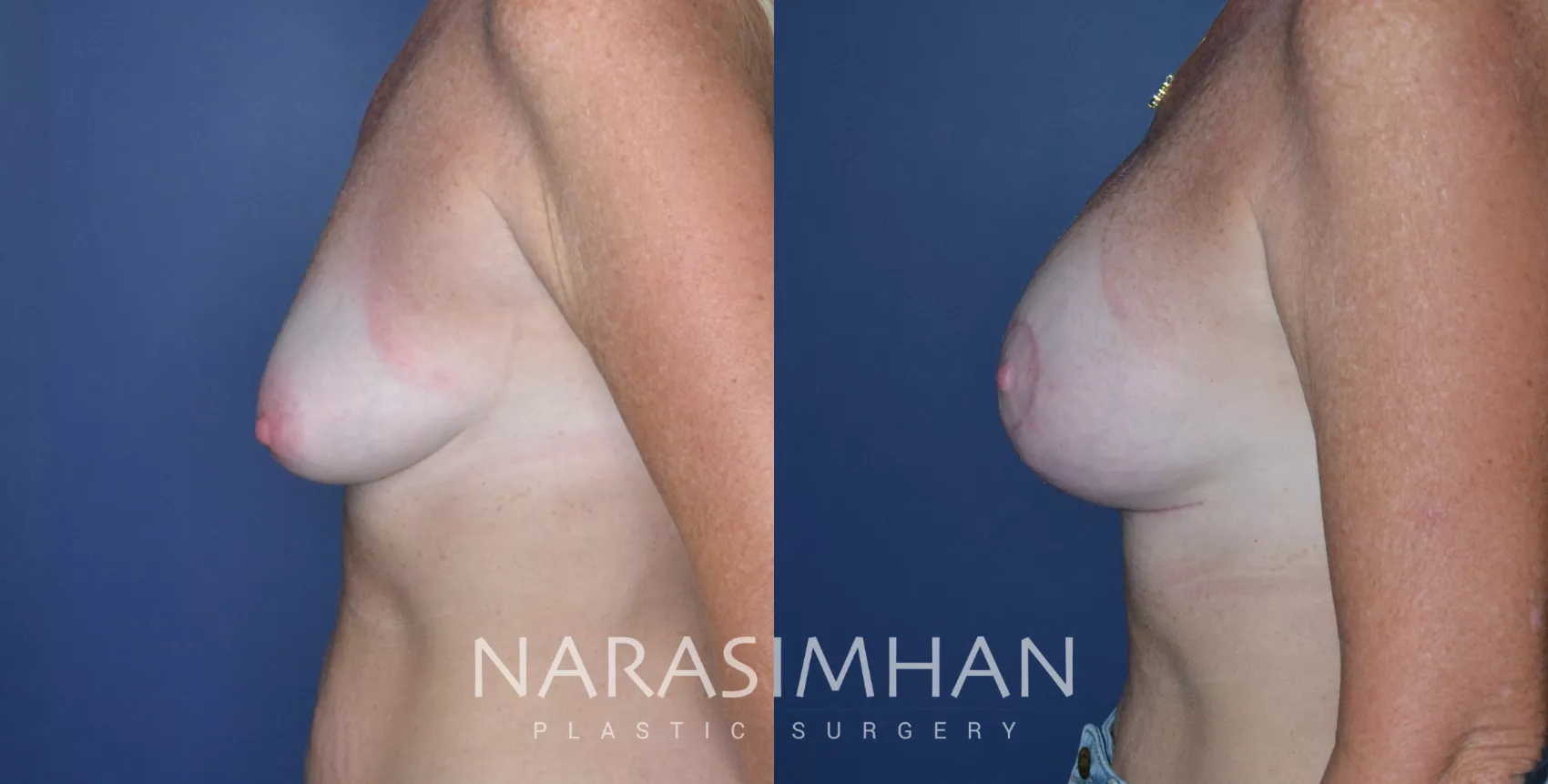 breast-augmentation-with-lift-mastopexy-239-view-1-detail (1)