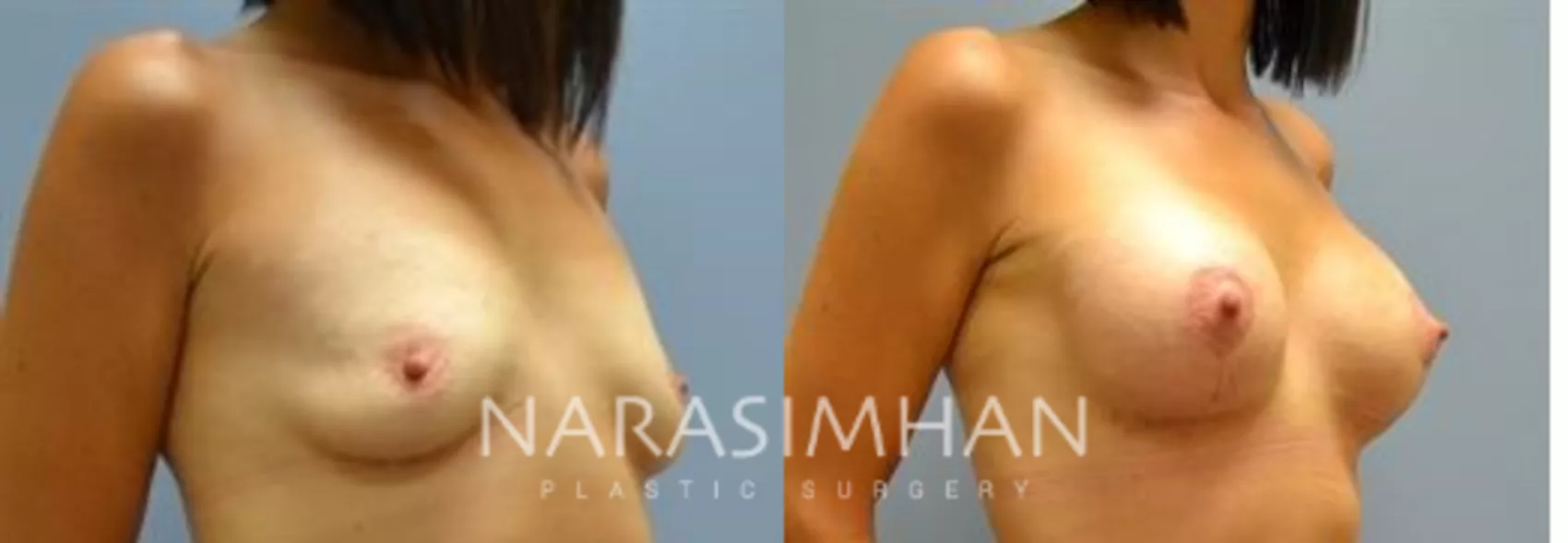 breast-augmentation-with-lift-mastopexy-33-view-1-detail