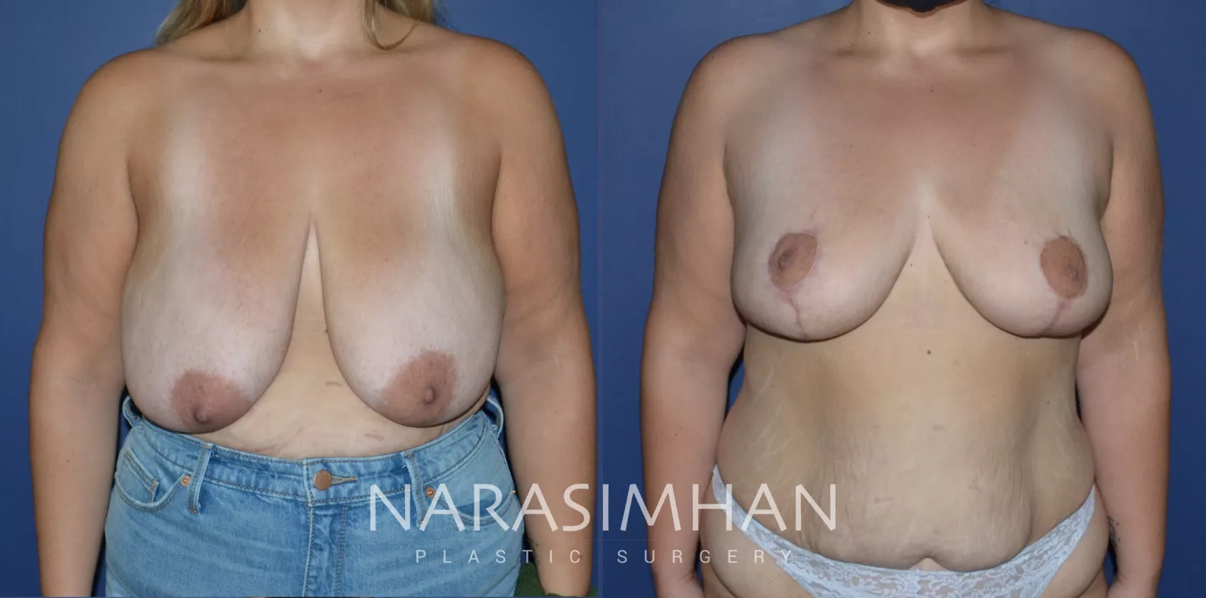 breast-reduction-218-view-1-detail