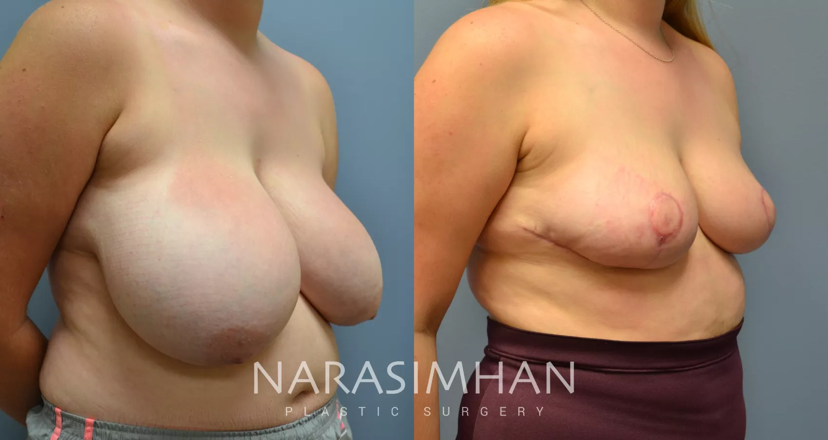 breast-reduction-44-view-1-detail