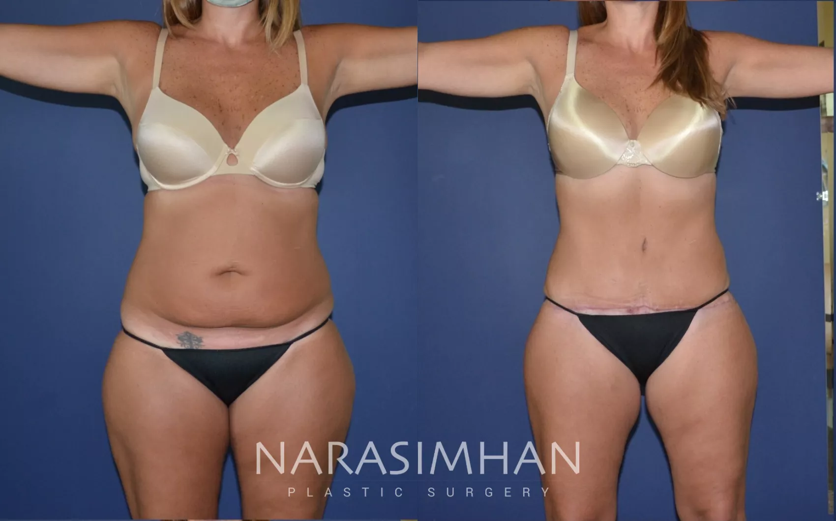 tummy-tuck-abdominoplasty-179-view-1-detail