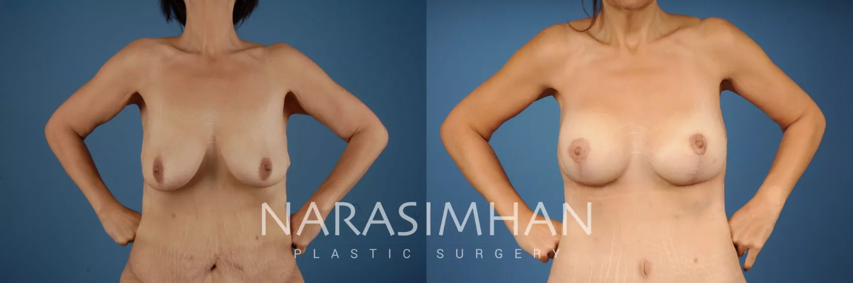 tummy-tuck-abdominoplasty-208-view-1-detail