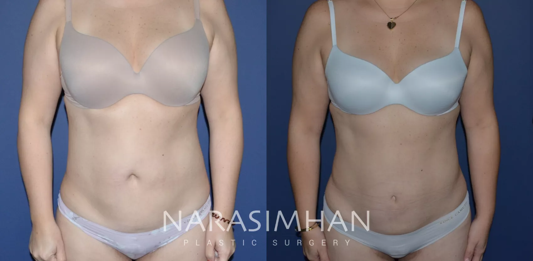 tummy-tuck-abdominoplasty-235-view-1-detail